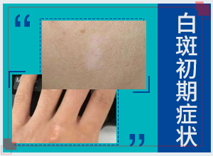 白點風能治療嗎-白點癲風早期可以治療嗎-正確起效治療