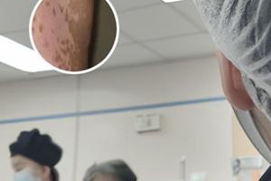 他克莫司軟膏治療白斑有用嗎