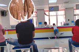 點斑后色素減退圖片高清